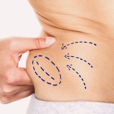 لیپوساکشن یا ابدومینوپلاستی؟