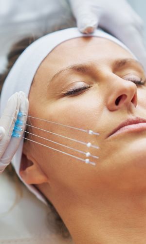 لیفت صورت با نخ